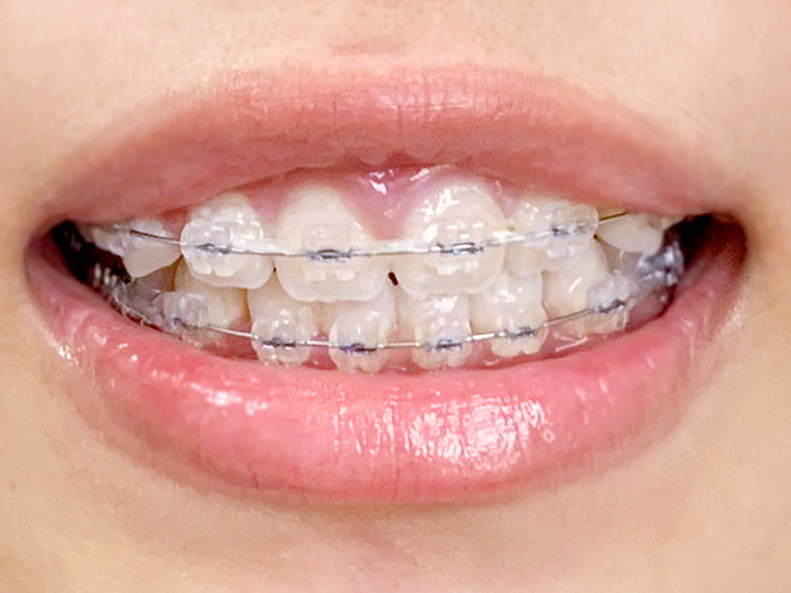 全体矯正の歯