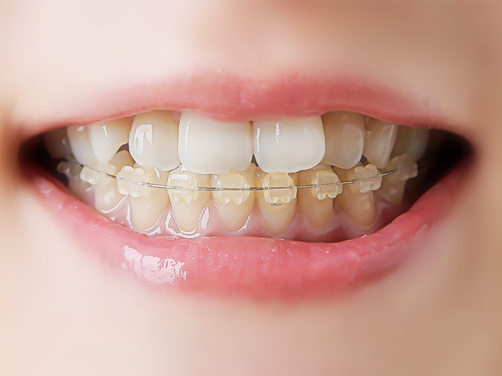 部分的な矯正の歯