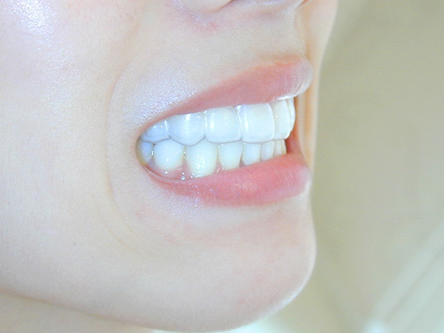 自然な美しい白い歯に。