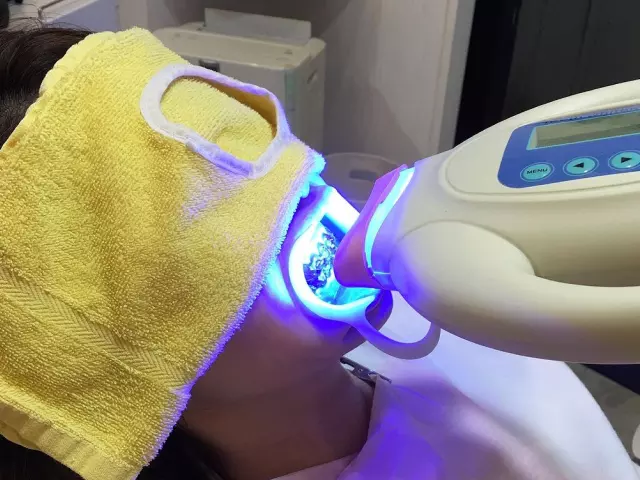 レーザー照射などのホワイトニング機器